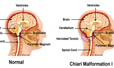 Neurochirurgie : La malformation de Chiari, une réalité