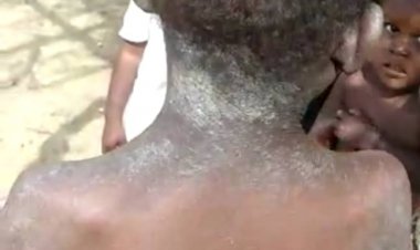 Alerte !!! Une maladie cutanée "hautement contagieuse" signalée en Haïti