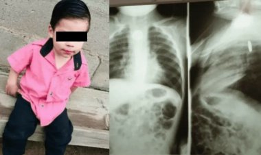 Un enfant de deux ans a avalé une batterie qui a explosé dans son ventre