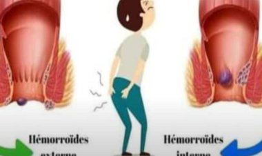 Voici comment se débarrasser des hémorroïdes rapidement par un traitement 100% naturel