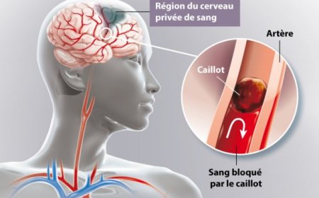 Les réflexes à avoir pour éviter l'AVC