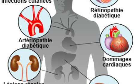Peut-on prévenir le diabète de type 2 ?