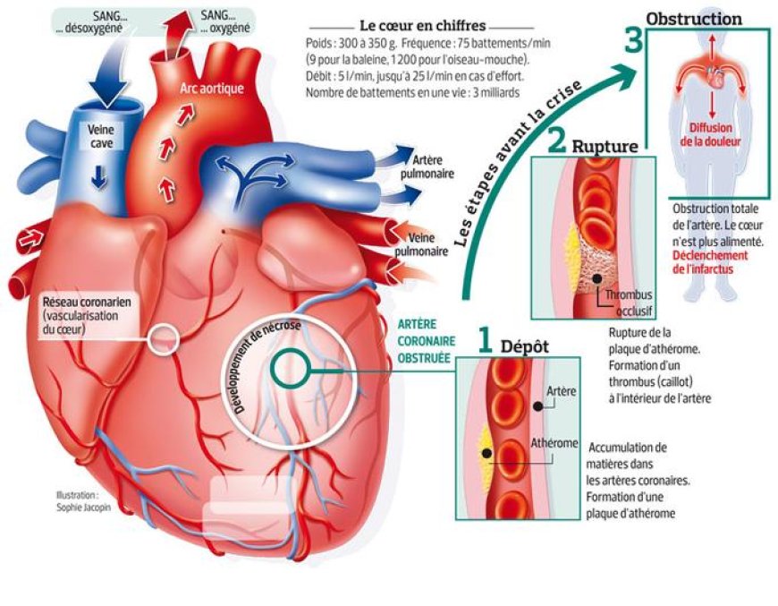L'infarctus du myocarde (crise cardiaque)