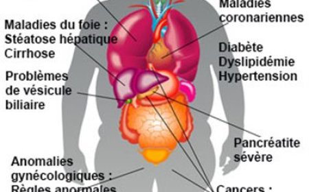 Obesité : quelles conséquences ?