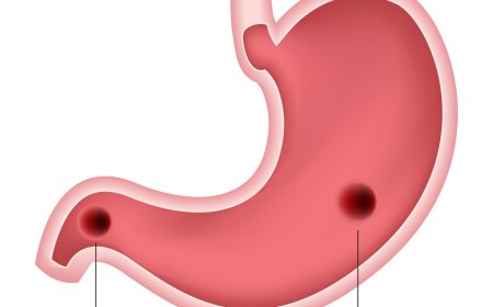 Ulcère gastro-duodénal : un tueur à feu doux